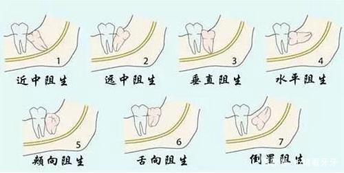 发炎的智齿什么时候拔才好？有些情况不能拔