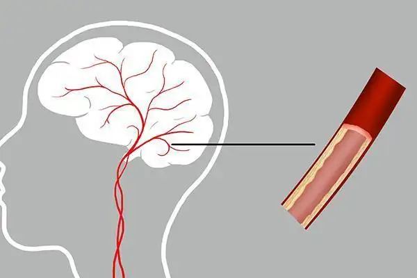 提醒中老年人：脑供血不足时，身体会发出4个信号！该如何治疗？