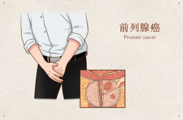 前列腺癌一发现就是晚期？注意这4个方面，远离它！