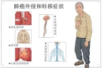 腿疼被诊断为肺癌晚期？腿上出现这4种现象，千万要注意！