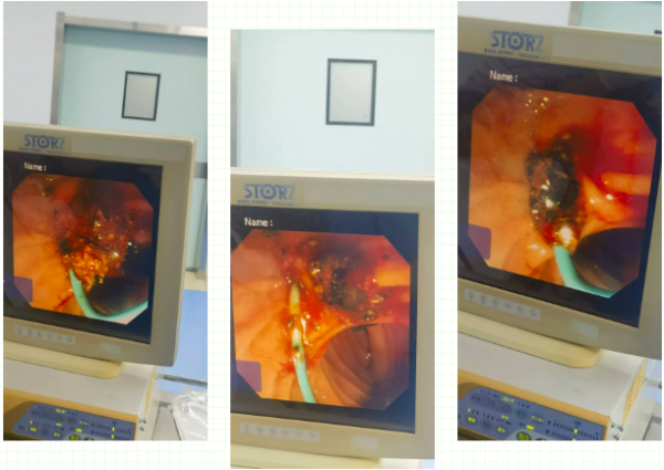 精湛技艺除病痛，携手合作创高效——我院消化科内镜室在外院专家指导下成功完成一例高难度ERCP胆总管取石术