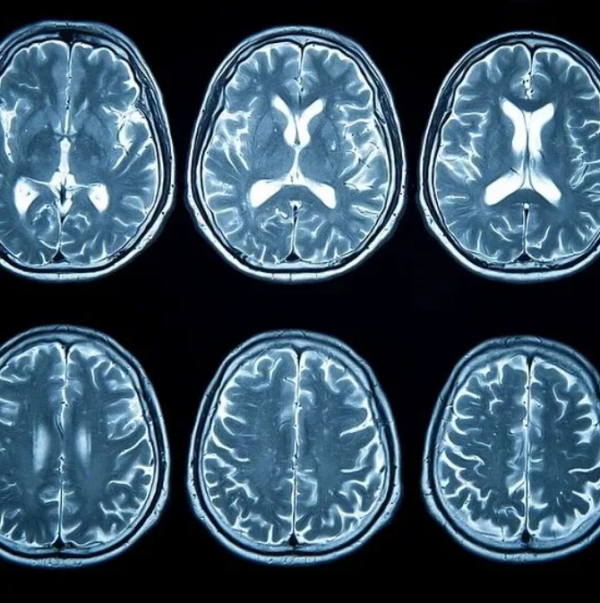 睡前有这 5 种表现，可能是脑梗！