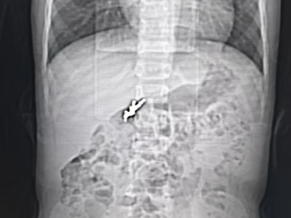 5厘米玩具手枪吞入腹！6岁男孩紧急手术，这些“夺命小物”一定要收好。